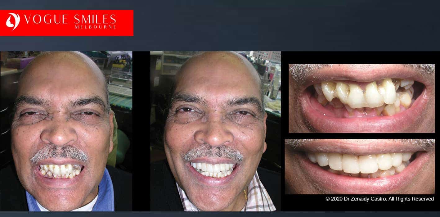 Is there a cheaper option than veneers?- Composite Veneers, Dental Bonding Melbourne CBD and Noble Park North