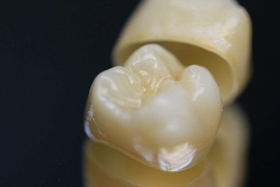 Dental Crowns Melbourne CBD, affordable dental crowns Melbourne, tooth capping promo offer