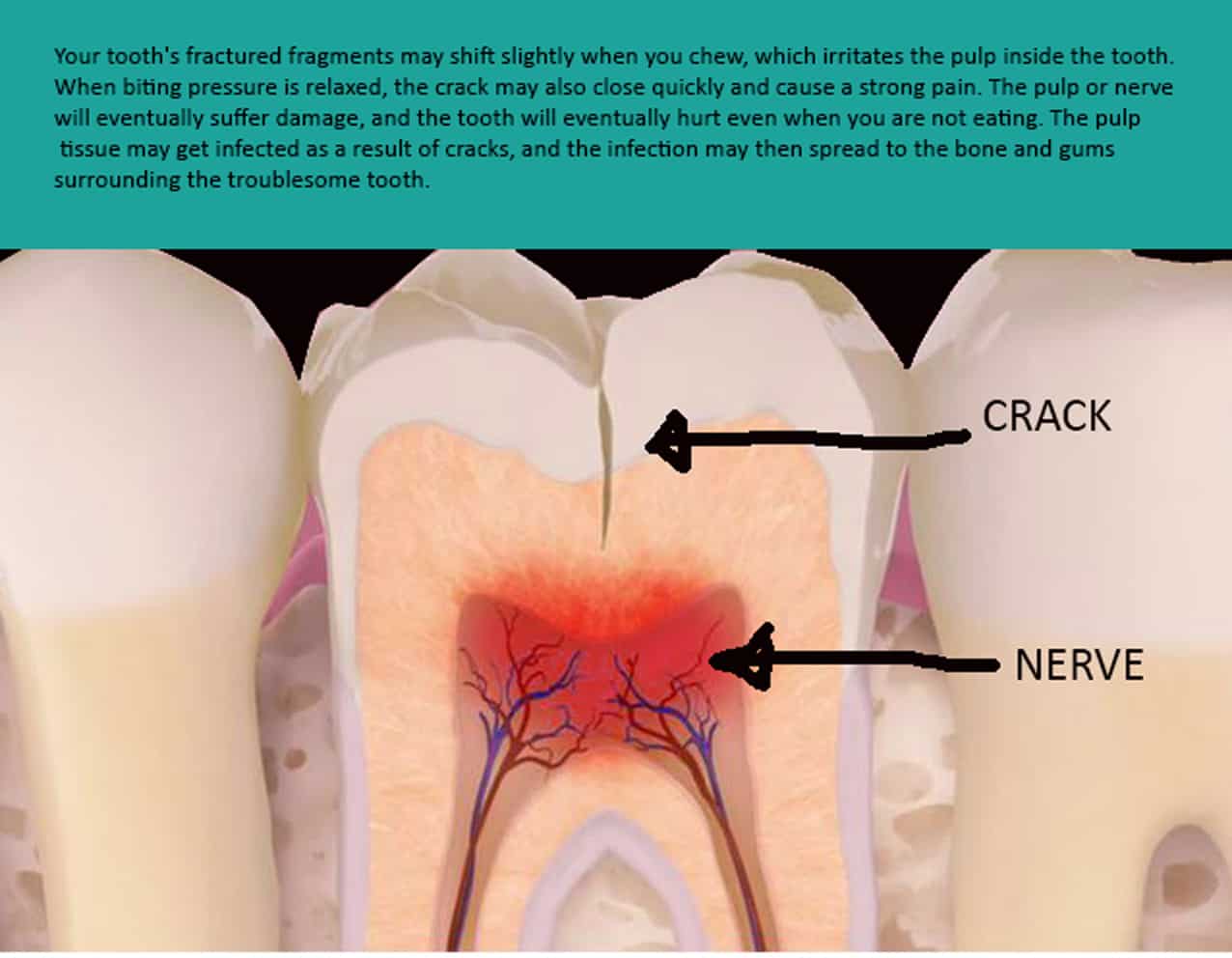 Cracked Tooth and Cracked Tooth Syndrome Treatment Melbourne 