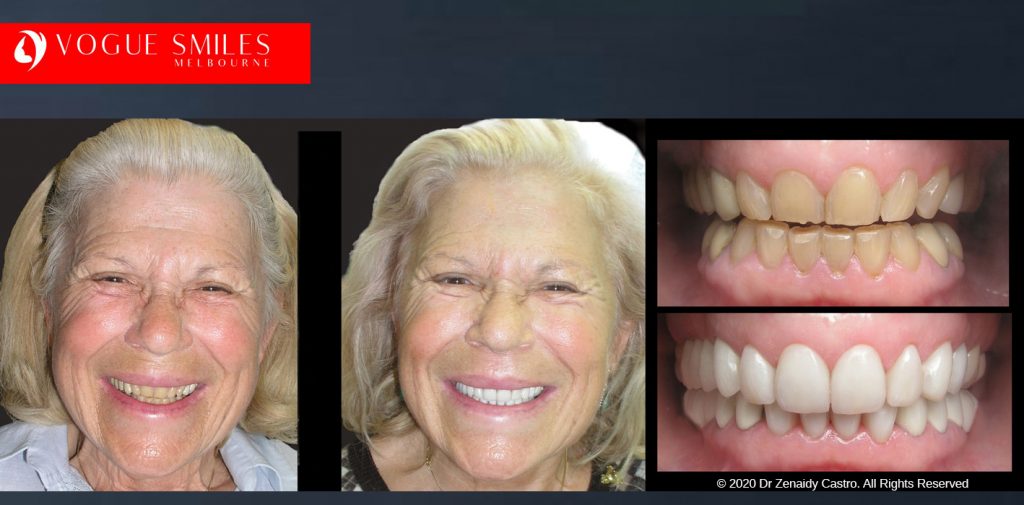 Anti-Aging Cosmetic Dentistry Melbourne Before and After - Best Cosmetic Dentist Melbourne CBD