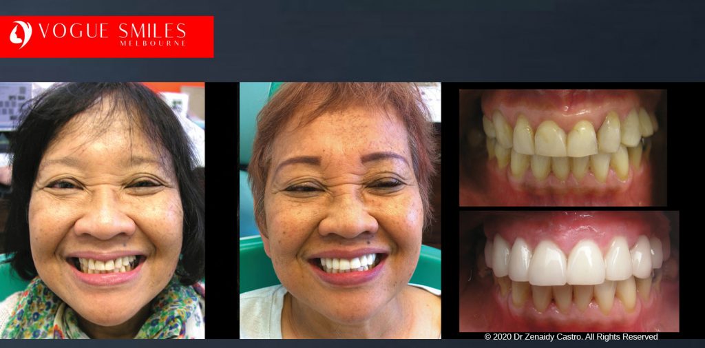 Anti-Aging Cosmetic Dentistry Melbourne Before and After - Best Cosmetic Dentist Melbourne CBD