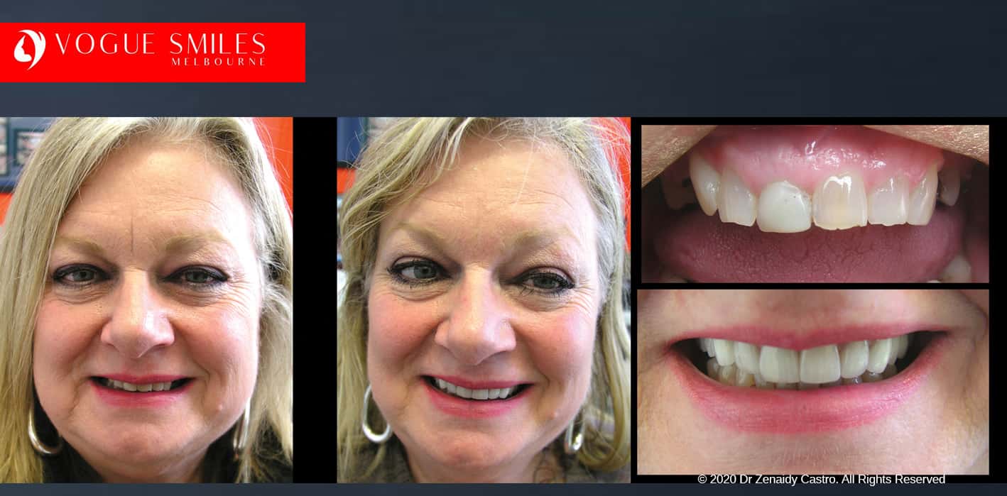 face lift dentistry near me - Anti Aging Melbourne - Cosmetic Dentistry Clinic- Before and after dental photos -VOGUE SMILES MELBOURNE