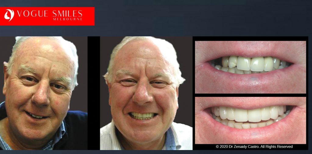 Anti-Aging Cosmetic Dentistry Melbourne Before and After - Best Cosmetic Dentist Melbourne CBD