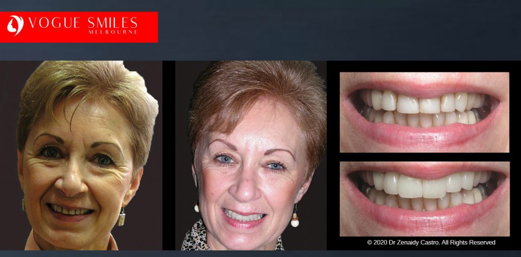 Anti-Aging Cosmetic Dentistry Melbourne Before and After - Best Cosmetic Dentist Melbourne CBD