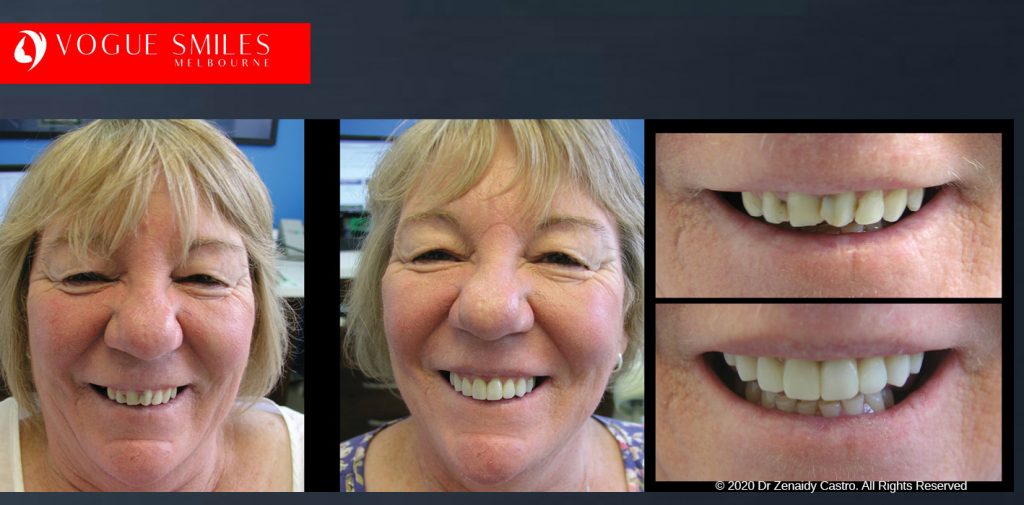 Anti-Aging Cosmetic Dentistry Melbourne Before and After - Best Cosmetic Dentist Melbourne CBD
