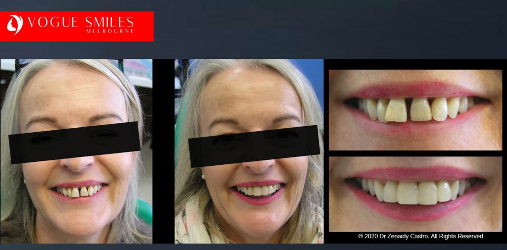 Anti-Aging Cosmetic Dentistry Melbourne Before and After - Best Cosmetic Dentist Melbourne CBD