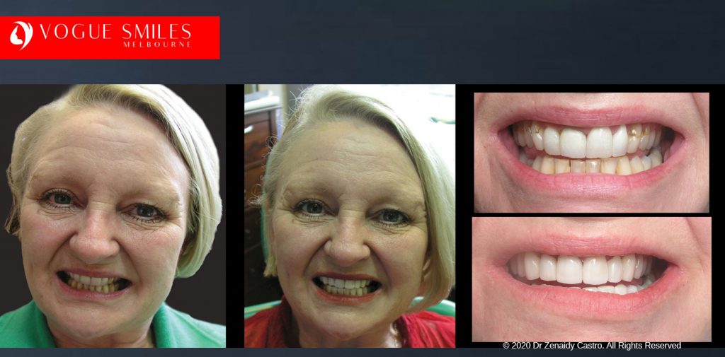 Anti-Aging Cosmetic Dentistry Melbourne Before and After - Best Cosmetic Dentist Melbourne CBD