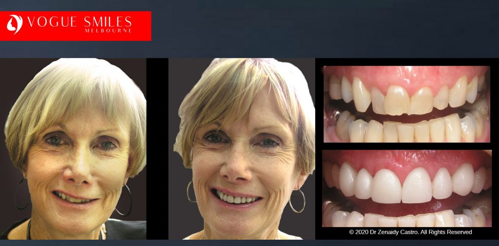 Anti-Aging Cosmetic Dentistry Melbourne Before and After - Best Cosmetic Dentist Melbourne CBD