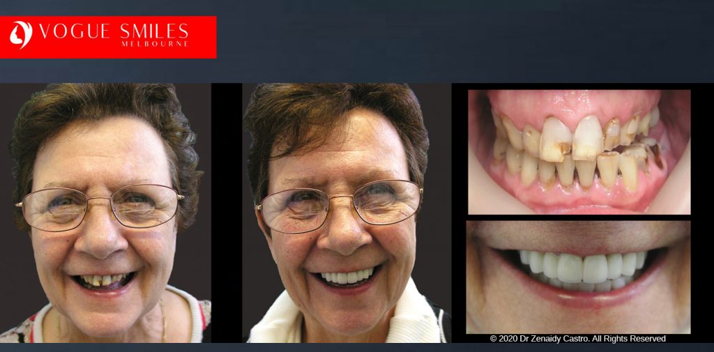 Anti-Aging Cosmetic Dentistry Melbourne Before and After - Best Cosmetic Dentist Melbourne CBD