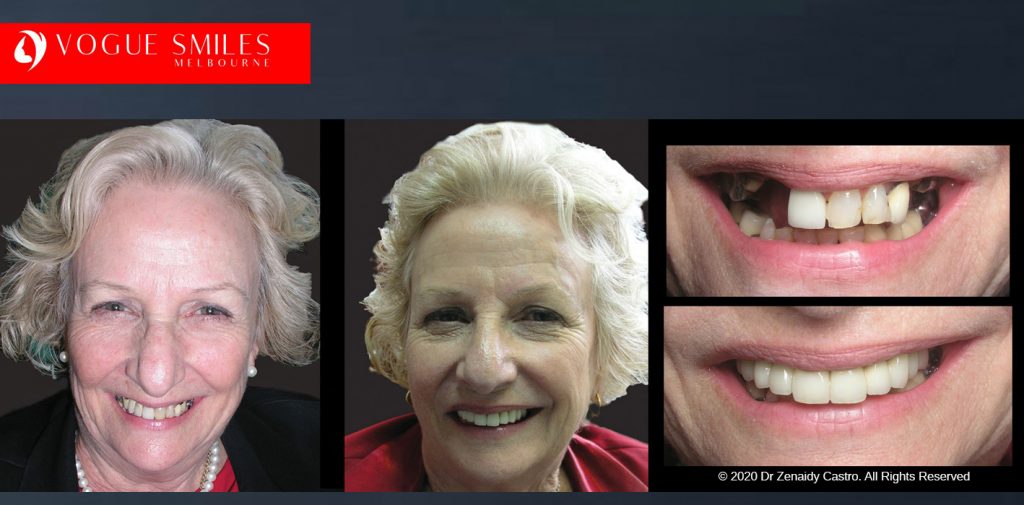 Anti-Aging Cosmetic Dentistry Melbourne Before and After - Best Cosmetic Dentist Melbourne CBD