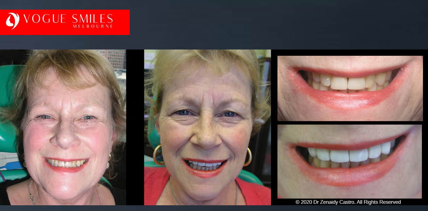 Anti-Aging Dentistry Before & After | Dental Facelift Photos -Facelift Before and After- Leading Cosmetic Dentist in Melbourne Australia