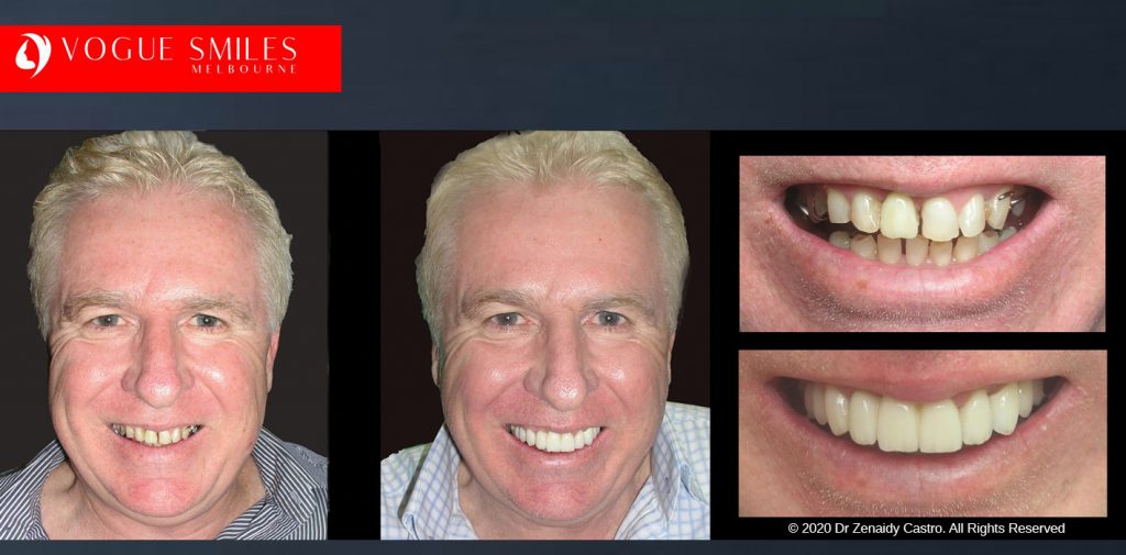 Anti-Aging Cosmetic Dentistry Melbourne Before and After - Best Cosmetic Dentist Melbourne CBD