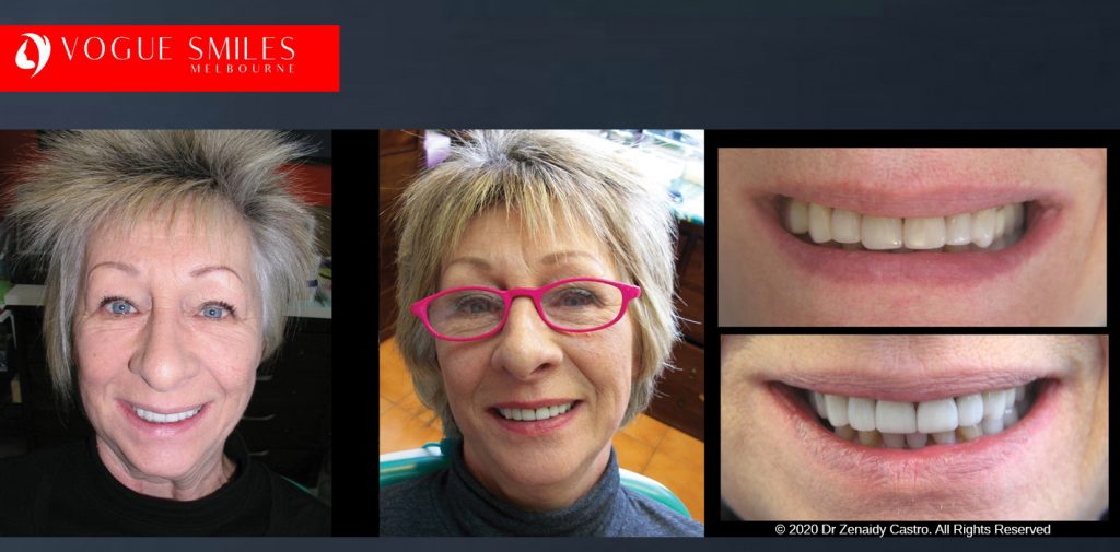 Anti-Aging Cosmetic Dentistry Melbourne Before and After - Best Cosmetic Dentist Melbourne CBD