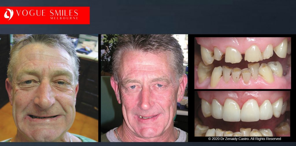 Anti-Aging Cosmetic Dentistry Melbourne Before and After - Best Cosmetic Dentist Melbourne CBD