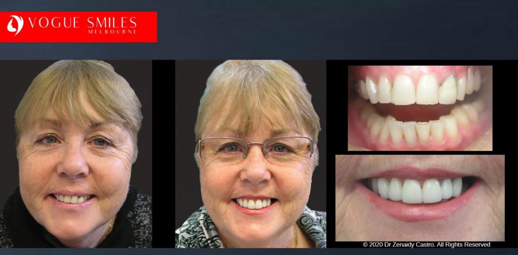 Anti-Aging Cosmetic Dentistry Melbourne Before and After - Best Cosmetic Dentist Melbourne CBD