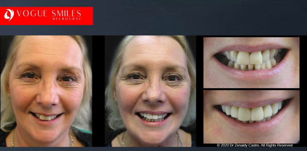 Anti-Aging Cosmetic Dentistry Melbourne Before and After - Best Cosmetic Dentist Melbourne CBD