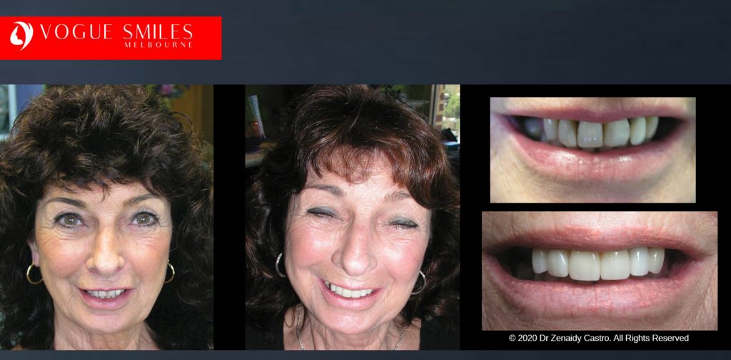 Anti-Aging Cosmetic Dentistry Melbourne Before and After - Best Cosmetic Dentist Melbourne CBD