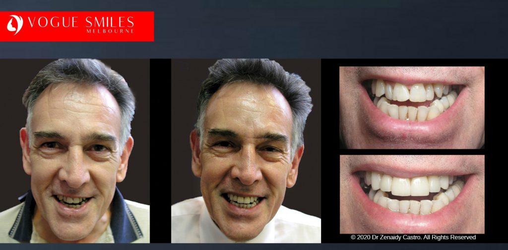 Anti-Aging Cosmetic Dentistry Melbourne Before and After - Best Cosmetic Dentist Melbourne CBD