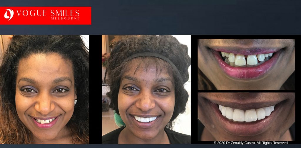 Before and After Smile Makeovers Melbourne - Australia's Top Cosmetic Dentist - VOGUE SMILES MELBOURNE