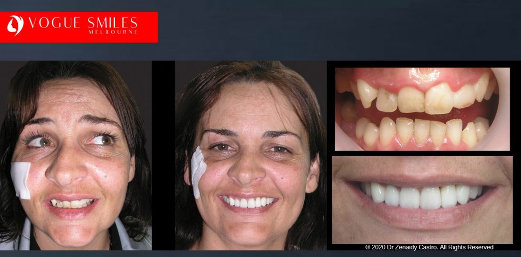 Before and After Smile Makeovers Melbourne - Australia's Top Cosmetic Dentist - VOGUE SMILES MELBOURNE