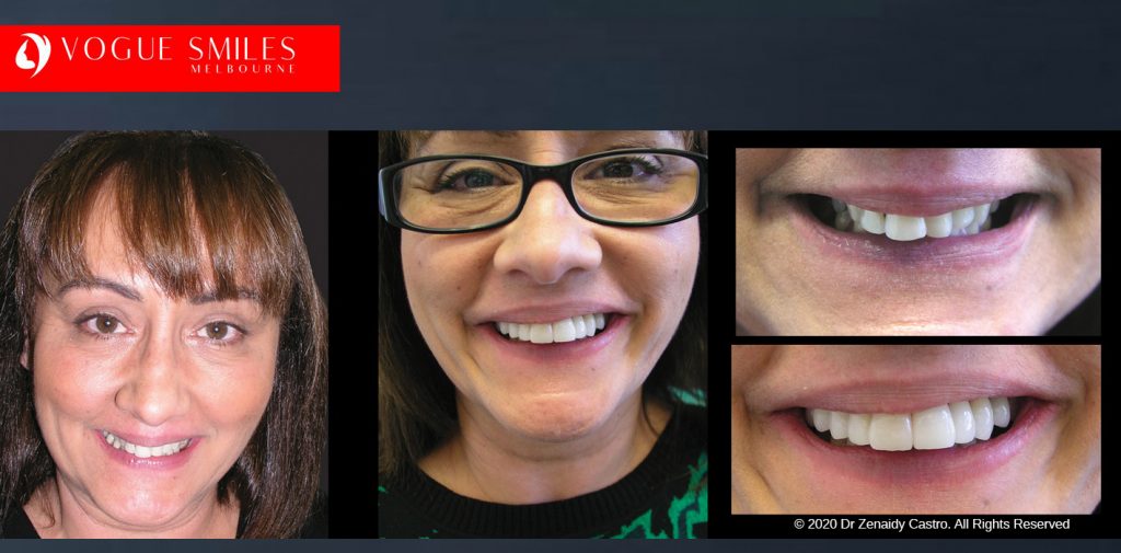 Before and After Smile Makeovers Melbourne - Australia's Top Cosmetic Dentist - VOGUE SMILES MELBOURNE