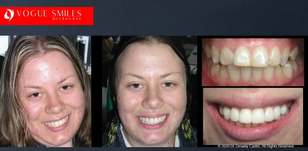 Before and After Smile Makeovers Melbourne - Australia's Top Cosmetic Dentist - VOGUE SMILES MELBOURNE