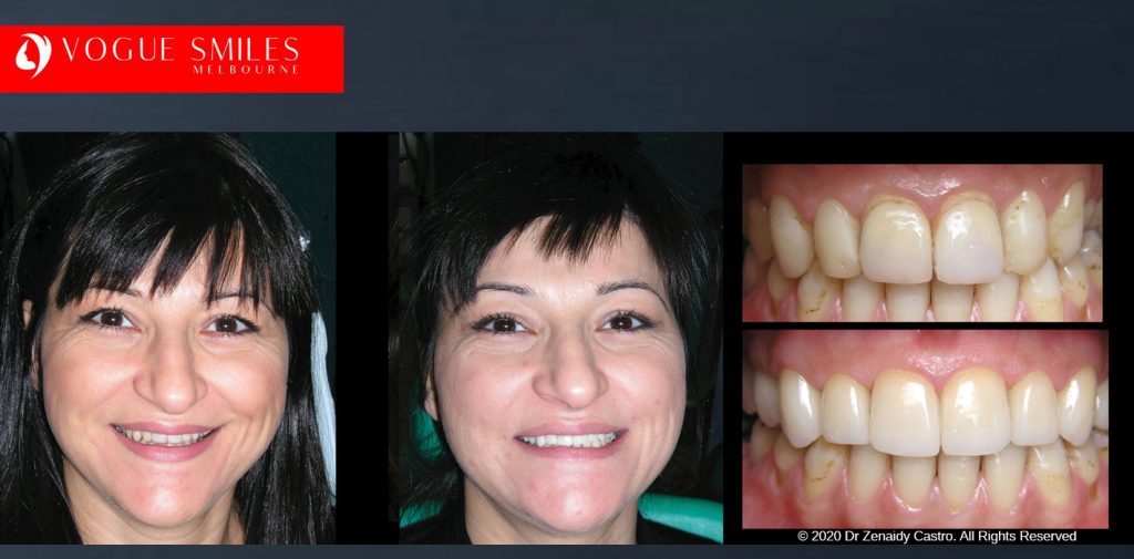 Before and After Smile Makeovers Melbourne - Australia's Top Cosmetic Dentist - VOGUE SMILES MELBOURNE