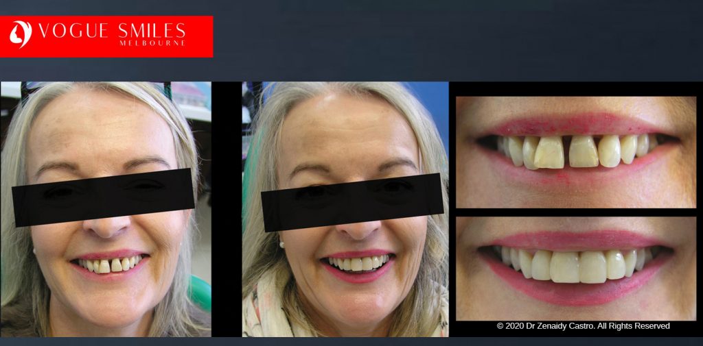 Before and After Smile Makeovers Melbourne - Australia's Top Cosmetic Dentist - VOGUE SMILES MELBOURNE