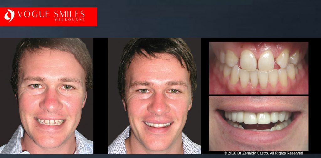 Before and After Smile Makeovers Melbourne - Australia's Top Cosmetic Dentist - VOGUE SMILES MELBOURNE