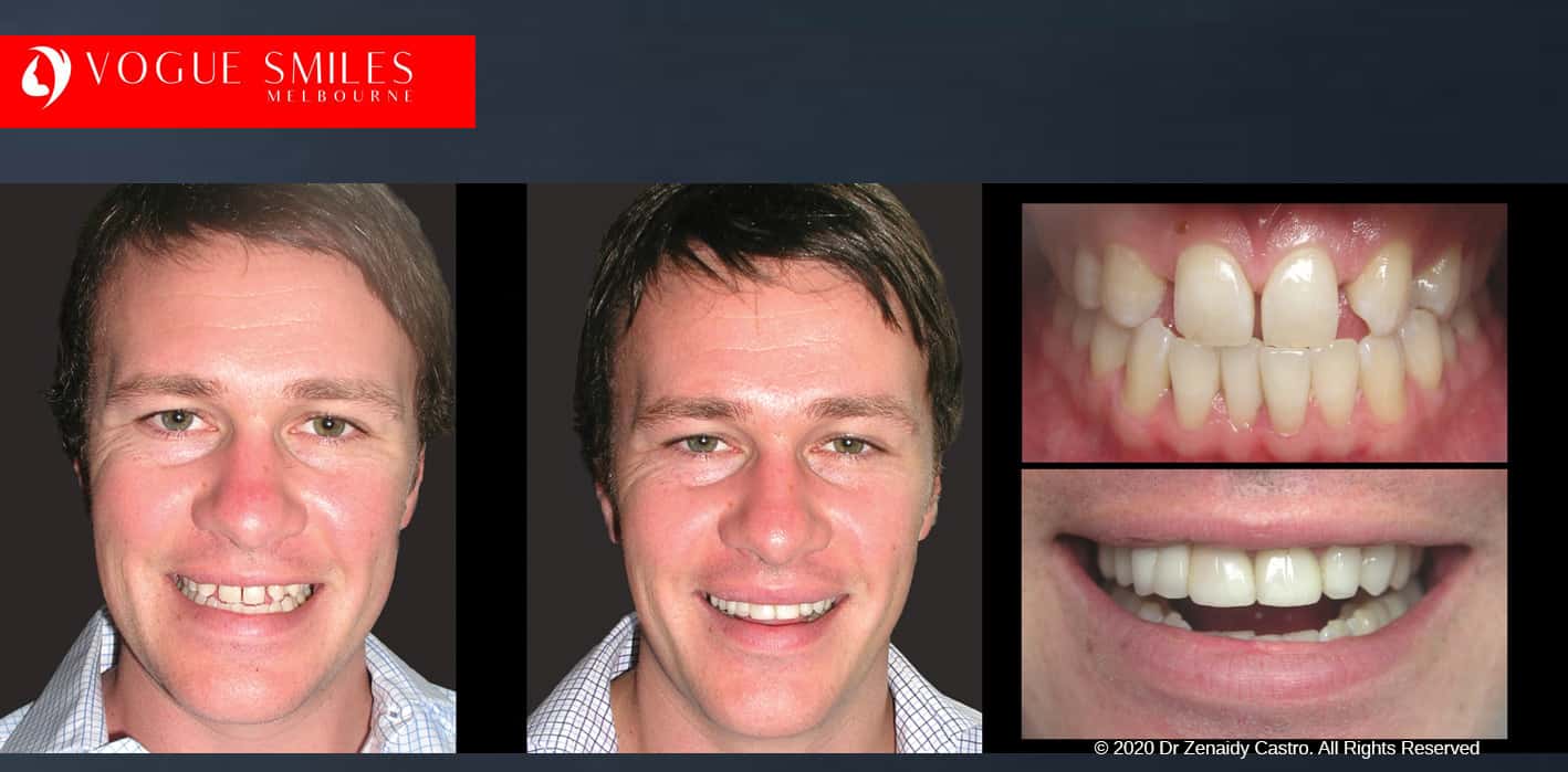 Before and After Cosmetic Dentistry Gallery Melbourne CBD