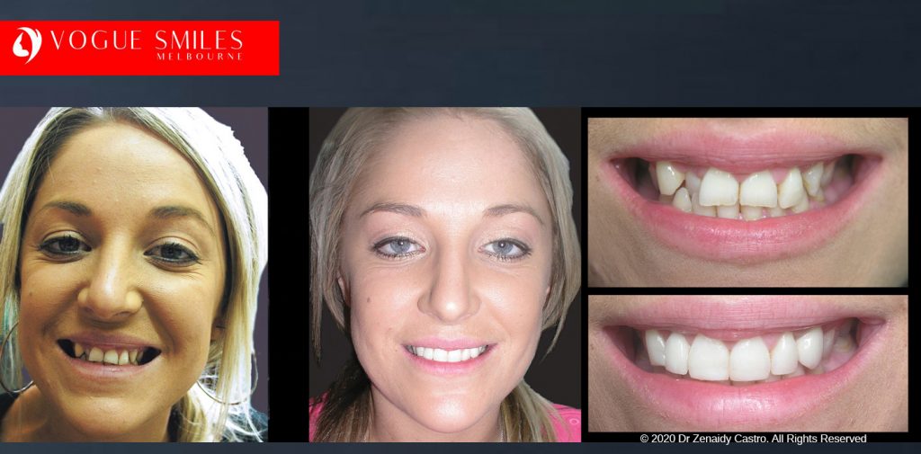 Before and After Smile Makeovers Melbourne - Australia's Top Cosmetic Dentist - VOGUE SMILES MELBOURNE