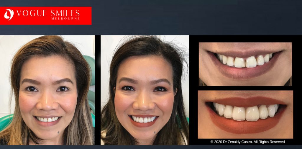 Before and After Smile Makeovers Melbourne - Australia's Top Cosmetic Dentist - VOGUE SMILES MELBOURNE