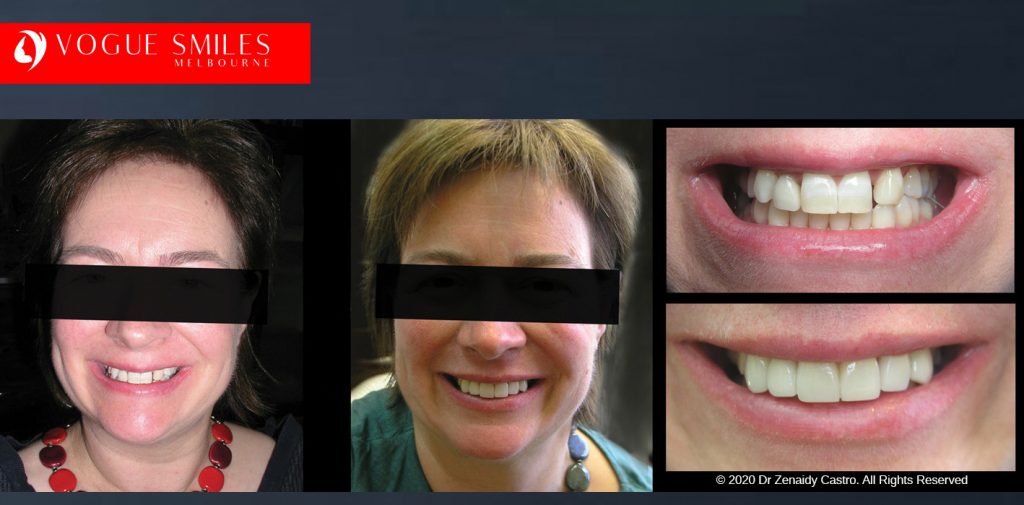 Before and After Smile Makeovers Melbourne - Australia's Top Cosmetic Dentist - VOGUE SMILES MELBOURNE