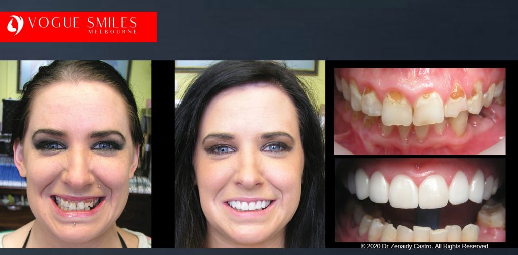 Before and After Smile Makeovers Melbourne - Australia's Top Cosmetic Dentist - VOGUE SMILES MELBOURNE