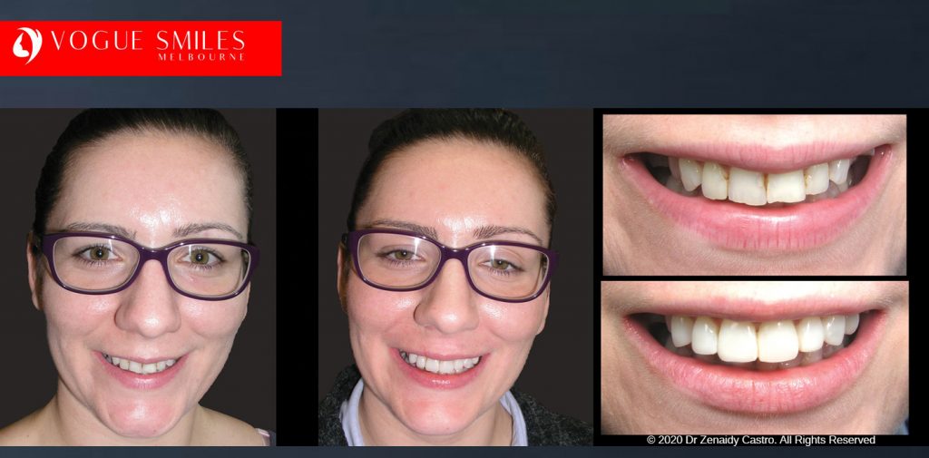 Before and After Smile Makeovers Melbourne - Australia's Top Cosmetic Dentist - VOGUE SMILES MELBOURNE