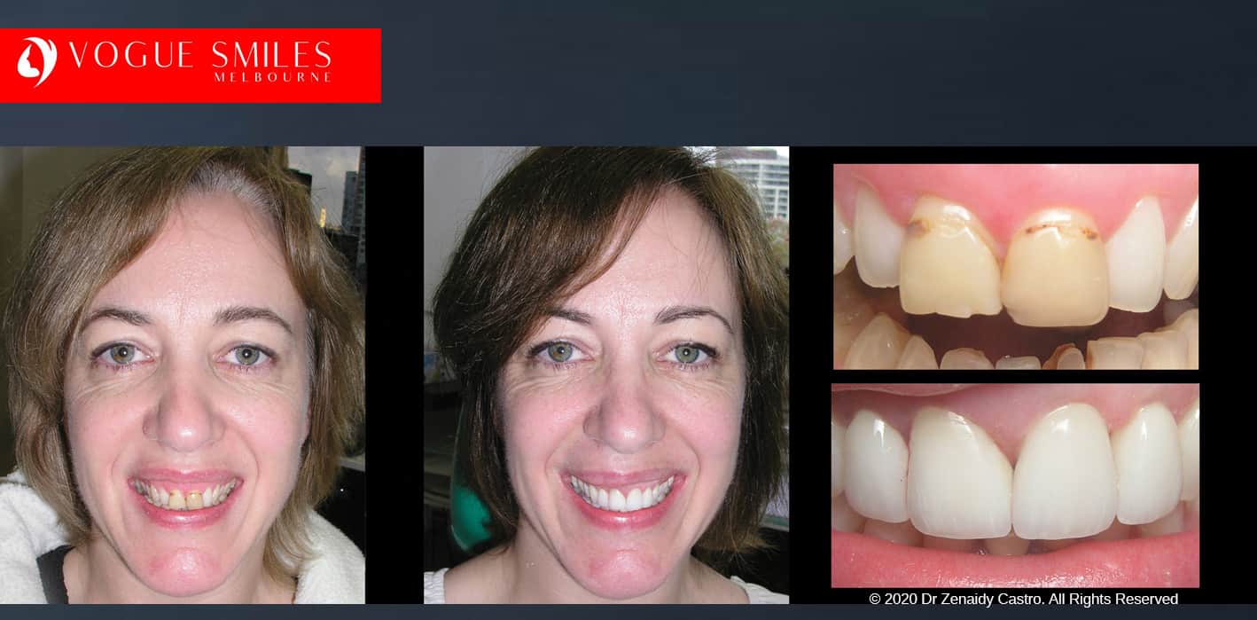 COSMETIC DENTIST NEAR ME - Before and After Cosmetic Treatment Gallery Melbourne CBD
