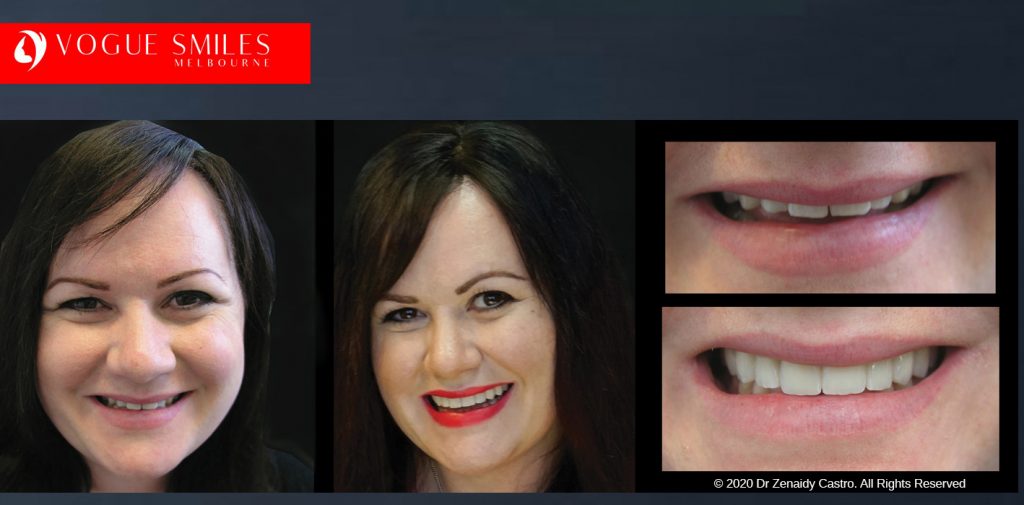 Before and After Smile Makeovers Melbourne - Australia's Top Cosmetic Dentist - VOGUE SMILES MELBOURNE