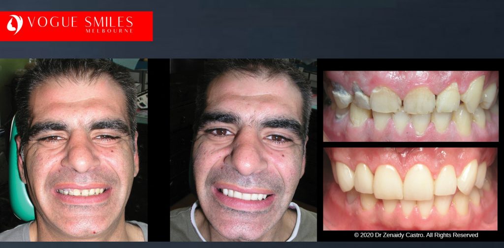 Before and After Smile Makeovers Melbourne - Australia's Top Cosmetic Dentist - VOGUE SMILES MELBOURNE