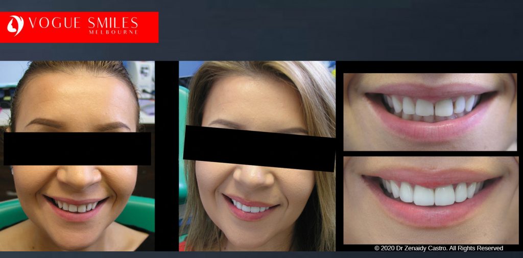 Before and After Smile Makeovers Melbourne - Australia's Top Cosmetic Dentist - VOGUE SMILES MELBOURNE