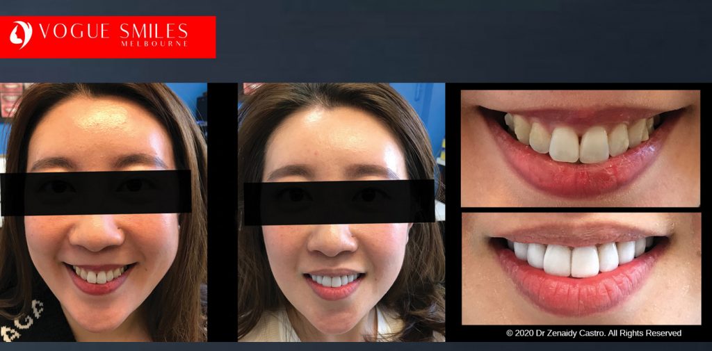 Before and After Smile Makeovers Melbourne - Australia's Top Cosmetic Dentist - VOGUE SMILES MELBOURNE