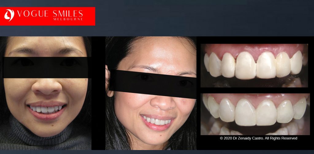 Before and After Smile Makeovers Melbourne - Australia's Top Cosmetic Dentist - VOGUE SMILES MELBOURNE