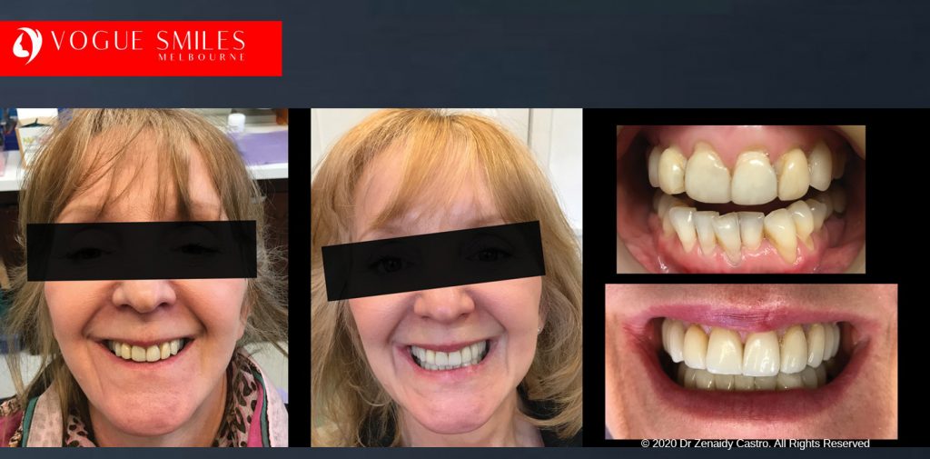 Before and After Smile Makeovers Melbourne - Australia's Top Cosmetic Dentist - VOGUE SMILES MELBOURNE