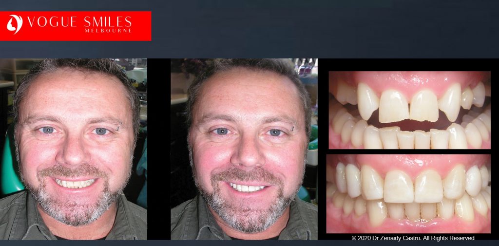 Before and After Smile Makeovers Melbourne - Australia's Top Cosmetic Dentist - VOGUE SMILES MELBOURNE