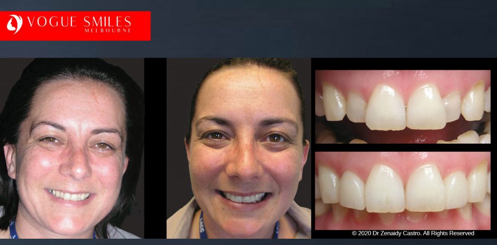 Before and After Smile Makeovers Melbourne - Australia's Top Cosmetic Dentist - VOGUE SMILES MELBOURNE