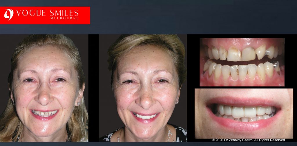 Before and After Smile Makeovers Melbourne - Australia's Top Cosmetic Dentist - VOGUE SMILES MELBOURNE