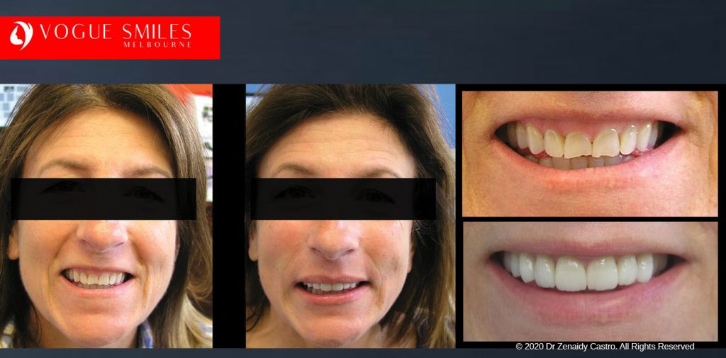 Before and After Smile Makeovers Melbourne - Australia's Top Cosmetic Dentist - VOGUE SMILES MELBOURNE