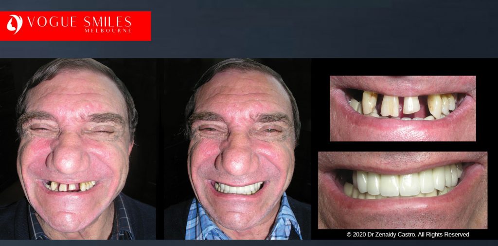 Before and After Smile Makeovers Melbourne - Australia's Top Cosmetic Dentist - VOGUE SMILES MELBOURNE