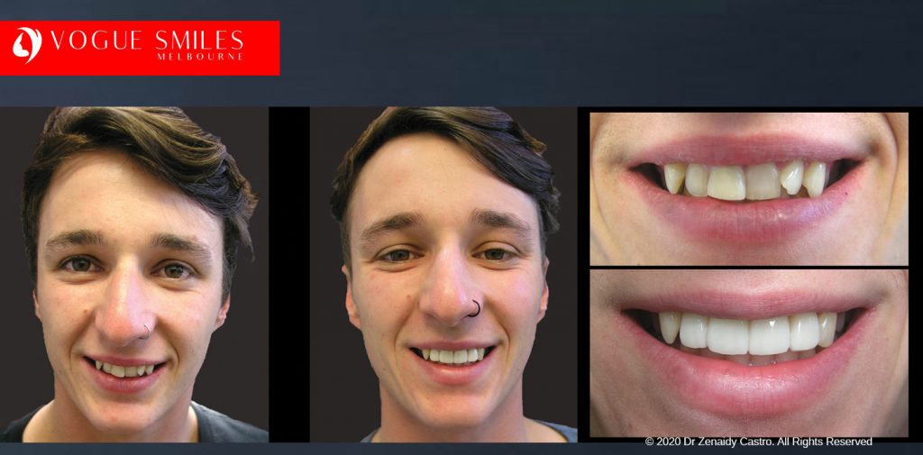 Before and After Smile Makeovers Melbourne - Australia's Top Cosmetic Dentist - VOGUE SMILES MELBOURNE