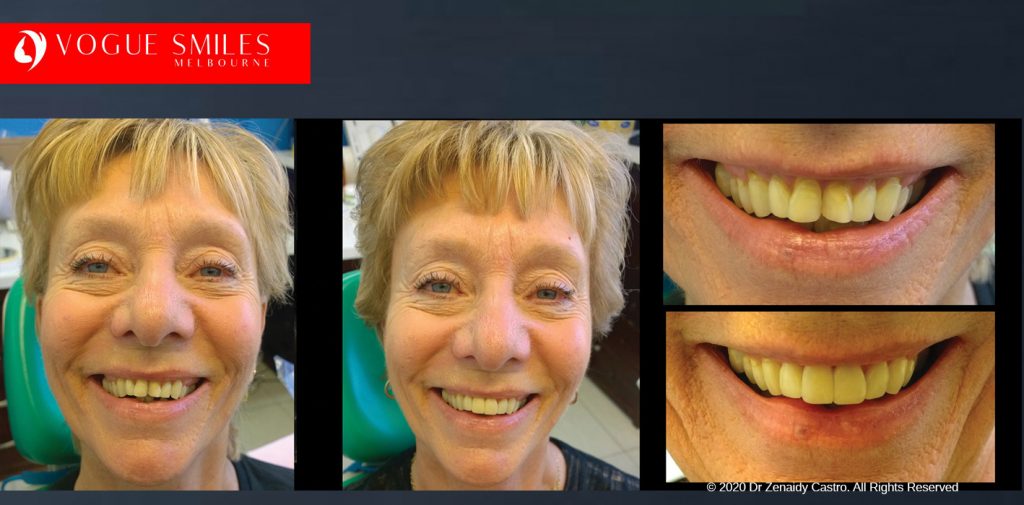 Before and After Smile Makeovers Melbourne - Australia's Top Cosmetic Dentist - VOGUE SMILES MELBOURNE