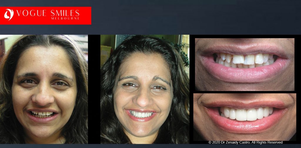 Before and After Smile Makeovers Melbourne - Australia's Top Cosmetic Dentist - VOGUE SMILES MELBOURNE